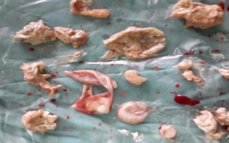 Figure 4: Cut section of lesion showed laminated daughter cyst with calcification.