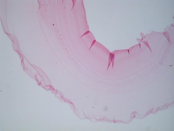 Figure 5: Histopathology showed laminated membrane beneath germinal layer. Patient diagnosed as primary hydatid cyst of intestine and underwent laparotomy and excision of affected segment of intestine (Figures 3 & 4), post operative period is uneventful. Histopathological examination confirmed features of hydatid cyst of intestine (Figure 5). Patient on post operative prophylaxis for 3 months on albendazole. No recurrence noted during follow-up.