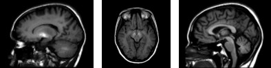 Figure 10: “Brain MRI T1-weighted sequence of a patient with ephedrone encephalopathy”: A) T1 hyper intense signal in the cerebellar white matter and globi pallidi, B) cerebral peduncles, and C) anterior pituitary gland “Courtesy of Okujava et al., 2017”[26].