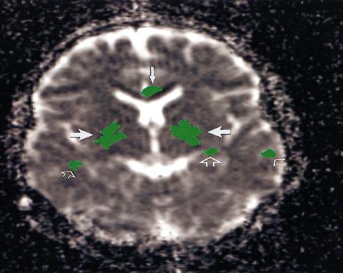 Figure 4: ADC map acquired after voxel evaluation to contrast “mean ADC values between ecstasy nonusers and ecstasy users.” The green areas denote considerably greater ADC values in ecstasy users versus ecstasy nonusers. These areas are localized in “the bilateral globi pallidi (thick solid arrows), the cingulate gyrus (thin solid arrow), the bilateral temporal cortex (small open arrows), and the left parahippocampal gyrus (large open arrow)” “Courtesy of Reneman et al., 2001” [11].