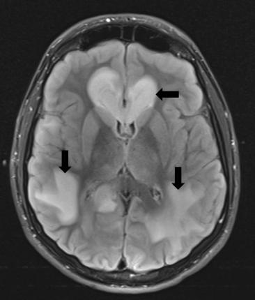 Figure 5: MRI of the brain of 16 y/o boy presenting with seizure 18 months prior to ingestion of N-bomb. There is increased T2-weighted signal intensity (black arrows) showing toxic leukoencephalopathy “Courtesy of Humston et al., 2017” [14].