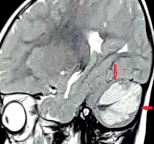Figure 8: 3 y/o following ingestion of methadone demonstrating diffuse cerebellar edema manifested by diffuse FLAIR hyper intensity involving the bilateral cerebellar hemispheres in a patient under the influence of synthetic opioids “Courtesy of Hosseini et al., 2017 [22].