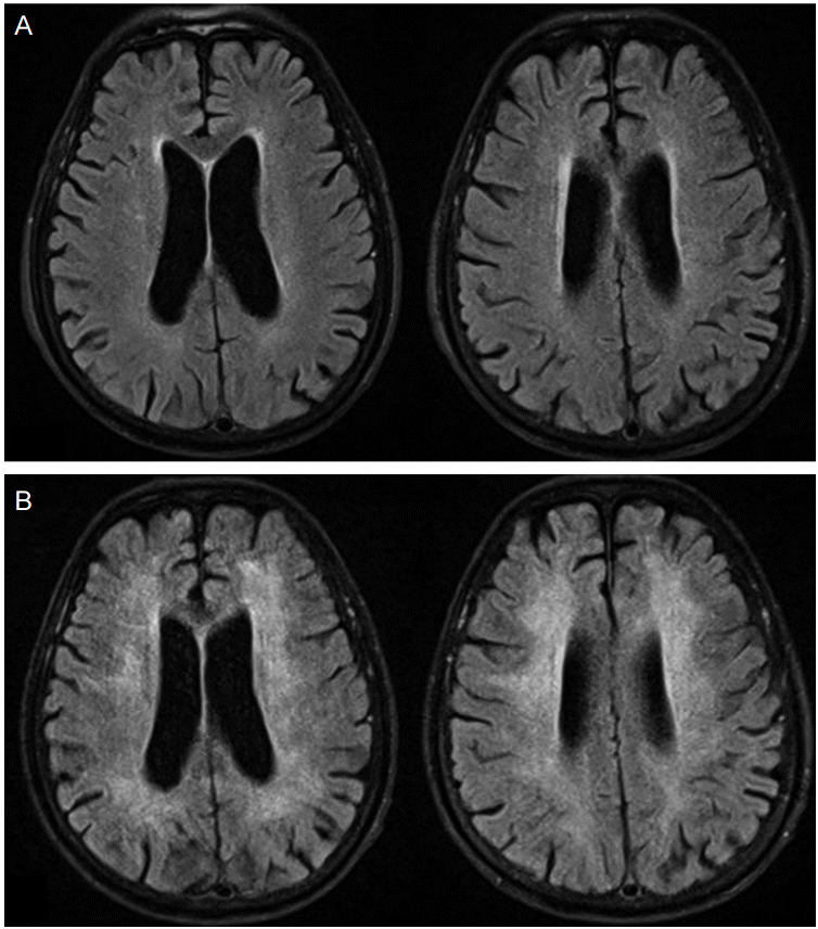Figure 9: FLAIR images of the patient A) on initial admission and B) 40 days following contact with fentanyl patch reveals symmetrical areas of signal hyperintensity in the deep and periventricular white matter, bilaterally, excluding the gray matter “Courtesy of Sub Yoo, et al., 2015” [23].