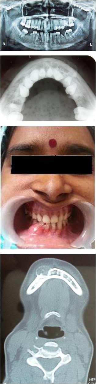 Figure 1: Intraoral view of lesion. Orthopantomogram revealed a non corticated, pear shaped, mixed radiopaque and radiolucent lesion with indistinct borders involving right parasymphyseal region of mandible (Figure 2a). The lesion extended from the alveolar crest to the region between the apices of the roots of the lateral incisor and first premolar teeth. The roots of these teeth were diverged but root resorption was not evident. The periodontal ligament spaces appeared to be intact. Mandibular occlusal view (Figure 2b) and CT axial view (Figure 2c) revealed expansion and perforation of buccal cortical plate. Needle aspiration failed to yield fluid.