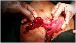 Figure 1: Ectopic pregnancy in distal portion of fallopian tube.