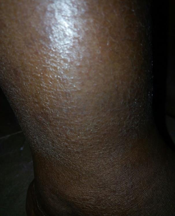 Figure 3: Day 7 of olanzapine withdrawal.