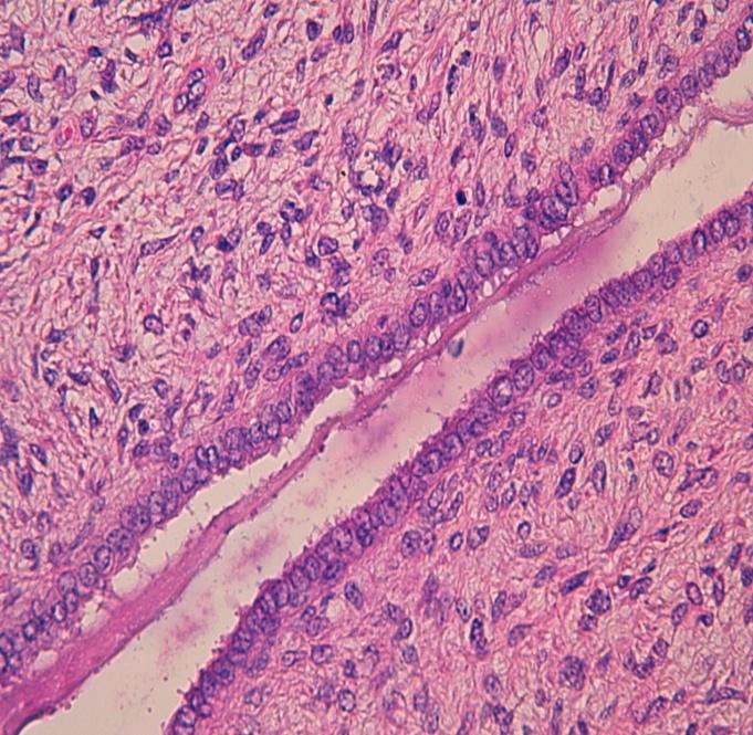 Figure 4: Areas of small, round cells that concentrate around the glandular elements forming peri-glandular cuffs (HESx10).