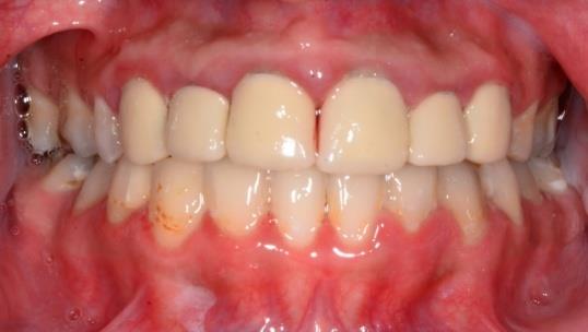 Figure 1: Pre-operative frontal view showing metal- ceramic crowns with inappropriate ratios and shade. Esthetic correction with glass ceramic (IPSe.max Press, IvoclarVivadent) for maxillary teeth (incisors, canines and premolars) was planned. After clinical examination, radiographs, photographs (Figure 3), impressions were made and mounted diagnostic wax-up (Figures 4 & 5) was performed taking into consideration the proper crown length to width ratios.