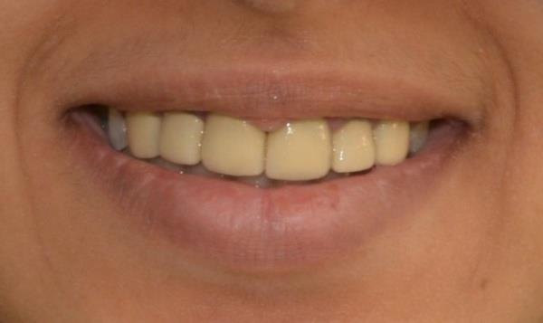 Figure 3: Pre-operative smile photo.