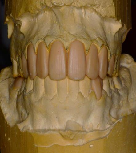 Figure 5: diagnostic wax-up. Two putty indices were made; one was used to guide the esthetic Gingivectomy and thereby verify the proper reduction. The other was used to perform interim crowns. First, the patient was recommended to take up initial periodontal preparation and to intensify oral hygiene before starting the rehabilitation process [8]. Second, the old crowns were removed using sectioning using diamond burs to cut through ceramic and fissure bur to cut through the metal. Sectioning was decided to avoid damaging the remaining tooth structure and this decision was encouraged by the fact that the wax-up based temporary crowns will look better than the existing restorations and give the patient an impression about the increased length of the crowns to give an appropriate length to width ratio. Then, adjustment of the preparations was done; the treatment protocol should be as conservative as possible with less reduction of teeth structure and greater esthetics and longevity [9]. The shade of maxillary teeth was selected as 1M1using Vita 3D master and the preparations were performed with diamond burs for incisors canines and premolars and finish line for each tooth was a deep chamfer and respecting the shared preparation principles in the anterior and posteriors regions for all systems (i.e., single-unit and FPD abutment) include an incisal/occlusal reduction of 1.5mm