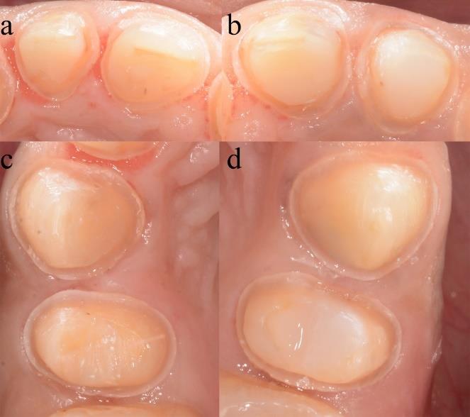 Figure 6: Teeth preparation (a) #12,11 (b) #21,22 (c) #13,14 (d) #23,24. The interim restorations (Figure 7) were carried out with resin acryl (protemp) by direct technique and aimed to restore esthetics and occlusal scheme to incorporate a definitive prosthesis in future and it provided time for evaluation of design and occlusal form before deciding to proceed with definitive restoration. Long term provisionalization should be employed when concerns exist regarding initial health and stability of the gingiva, and to ensure esthetics, occlusion, and phonetics [11,12]. Proper temporization with proper contours along with the increased awareness of patient's oral hygiene showed a great improvement of the gingival inflammation.