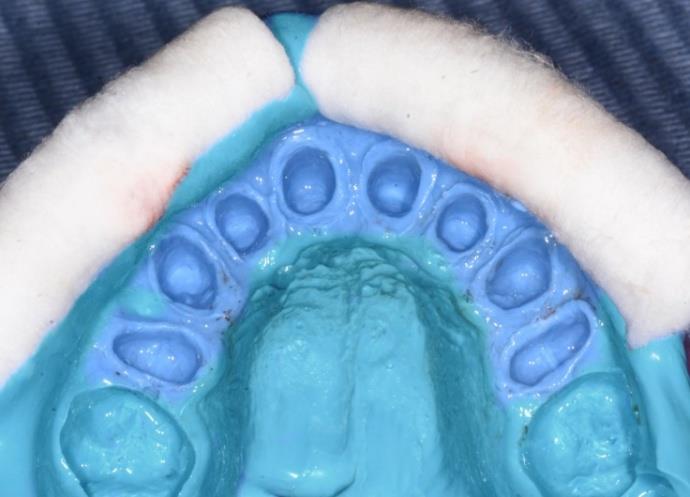 Figure 8: Final impression. In the clinic the bisque was checked to evaluate esthetics, shade, marginal fit, and proximal contacts. On the other hand centric and eccentric occlusion and phonation were verified. Once patient approval was insured, glazing was performed in the lab. Before cementation, care must be taken to the order of the eight crowns seating in the arch which could jeopardize their correct path of insertion. After etching the inner surfaces of the disilicate crowns with 10% of hydrofluoric acid for 20 seconds and drying, a coat of silane coupling agent was applied for 1 minute [14]. On the other hand the abutments were cleaned to be sure that temporary cement is removed. According to the manufacturer instruction etching & bonding was unnecessary. Finally the cementation of the crowns was performed by a dual cure luting agent Rely X U 200(3M ESPE) using the quarter technique (Figures 9-11).