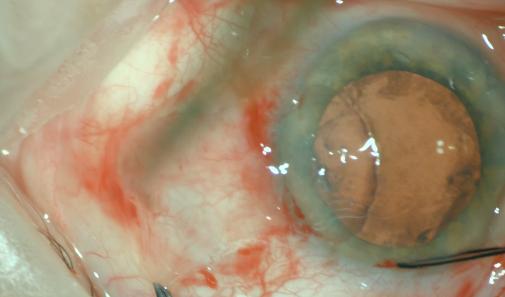 Figure 2: Preparation of surgical excision.