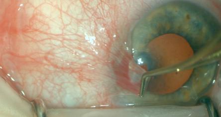 Figure 3: Conjunctival autograft overlying excised pterygium tissue Surgical removal of pterygia can improve the ocular surface leading to decreased discomfort, irritation, and a reduction in induced astigmatism. Improving the induced astigmatism does not normalize the cornea; irregular topographic findings will persist. Yaycioglu, et al. found that there was a positive correlation between the preoperative size of the pterygium and the astigmatism degree. This also correlates to a greater change in astigmatism after surgical intervention. They also found that the method of surgery and type of grafting did not have a significant effect on the amount of astigmatic change [8]. This suggests that surgeons choose grafting techniques based on recurrence rate as opposed to refractive results. Although an increase in visual acuity (VA) is expected following surgical excision, corneal irregularity remains. Surgical excision is also a carefully made decision, weighing the benefits versus complications, as it is one of the most painful ophthalmic procedures. This case report illustrates the management of a patient who underwent bilateral, nasal pterygium removal. For years, he maintained “20/20” vision in each eye, ignoring the decreased contrast and peripheral aberrations. The case will examine how a scleral contact lens provided a significant increase in the quality of vision.