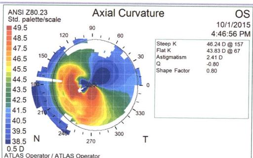 Figure 5: Example of an axial topography of a patient with a nasal pterygium. Due to the patient’s previous history of bilateral pterygia, it is important to understand the relationship between pterygia and astigmatism. In patients with pterygia, corneal astigmatism can be a combination of naturally occurring astigmatism and astigmatism induced by the pterygium. Pterygia are believed to cause corneal distortion through two possible mechanisms [4]. One proposed mechanism is the tractional forces of contractile elements within the pterygium mechanically distorting and flattening the cornea. The second mechanism involves the localized pooling of tears at the pterygium apex leading to an observation of corneal flattening by the topographer. Pterygia generally cause with-the-rule corneal astigmatism due to localized flattening towards the apex of the pterygium [4]. Mohammad-Salih et al. found correlations between the size of the pterygium and the amount of corneal astigmatism. They found a significant correlation between an increases in pterygium extension onto the cornea, increased the amount of induced astigmatism [11]. Since the size (width, extension, and area) can be a strong predictor of the induced astigmatism, this can also be seen as an indicator of surgical intervention, decreasing corneal distortion and visual disturbances. Surgical excision generally causes astigmatism and topographic irregularity to improve, leading to an improvement in visual acuity. Similar to previous studies, the degree of astigmatism reduction is related to the preoperative size of the pterygium [6]. Improving the amount of corneal astigmatism has shown to improve visual acuity. Surgical excision has shown improvement in the amount of corneal astigmatism but, unfortunately, the type of grafting does not have significant effect [8]. Tomidokoro, et al. summarizes by stating that surgical excision improves corneal astigmatism, but in advanced cases, does not completely normalize corneal distortion and irregularity. Persistent corneal irregularity and distortion in post- surgical pterygium removal is what this patient presented with. Spectacle correction would be the first line of treatment due to safety in a post-surgical patient [8]. The patient was correctable to a functional visual acuity, allowing him to perform activities of daily living, including driving, but still reported discomfort with spectacles due to distortions. Wave front guided surgical treatment would decrease the aberrations but would be contraindicated due to previous corneal pathology and surgical intervention. Penetrating keratoplasty would be another method to decrease, not resolve, optical aberrations leading from the corneal irregularity. This option is not indicated due to a clear, non-infectious cornea therefore the complications would outweigh possible benefits. The safest and most beneficial option to treat this patient would be a type of specialty contact lens. Post-pterygium removal corneas can rarely be fit with soft toric lenses. In mild irregularity cases, this may be an option but due to peripheral eccentricity and higher order aberrations, the soft lens may not provide good visual quality. In cases of irregular astigmatism, rigid gas permeable lenses have been shown to improve the visual acuity and quality. With an aligned fit, the concept is to create a regular refracting layer by the tear layer filling the space between the contact lens and cornea [7]. Another alternative to smaller diameter rigid gas permeable lenses may be hybrid lenses, a more comfortable alternative that provides equal vision improvement. The central gas permeable area corrects for irregular astigmatism while the soft skirt provides good comfort. With a similar concept and newer technology, there is a new option in the world of specialty contact lenses, the scleral lens. Scleral lenses provide a beneficial alternative option, whether it improves comfort, improves the fitting relationship between a contact lens and the cornea, and/or creates a safe environment for an already compromised cornea. These lenses are generally larger in size (14 mm to 20 mm), which can be very advantageous for the patient and the cornea. The landing zone of these lenses is on the less innervated sclera, leading to great comfort. Fortunately, the patient did not have signs of lens edge lift or impingement into the sclera at the landing zone. Toric peripheral curves can be designed in scleral lenses, in cases where one meridian may be flatter or steeper than the other. If conjunctival vessel impingement is observed, a toric peripheral landing is advised to evenly distribute the weight of the lens. Similar to a rigid gas permeable lens, a tear lens (non-preserved saline), is created between the contact lens and the cornea creating a regular, refracting surface [2]. Scleral lenses are generally fit based off of the sagittal depth, therefore higher amounts of cornea irregularity (i.e. advanced keratoconus) can be successfully fit. In the case of our patient, with irregular steepening only in the nasal meridian, it is hard to create a steepening effect only in one quadrant with an RGP without dislocation. A properly fit scleral, as the lens that was designed, can vault over the irregularity while providing great visual acuity. In recent years, scleral lenses have served to improve mainly refractive conditions, yet more research is being conducted on their therapeutic advantages. In this case, scleral lenses were an ideal solution for the patient [9]. He had expressed that he had attempted “hard” lenses when he was younger and did not want to pursue wearing them again. Unlike the other lens options, scleral lenses are traditionally costlier, from the fitting fee to the cost of the lenses, which proved immaterial to this patient. From the beginning, the patient had expressed interest in being able to see distance and near, which was provided using the chosen lens design. Scleral contact lenses require multiple solutions: non-preserved saline to fill the lens, a daily cleaner for gas permeable material, and a stronger cleaner for long term protein build up. Incorrect use of the recommended solutions can cause multiple complications. The use of multiple solutions can also be inconvenient for patients leading to noncompliance and causing complications. Insertion and removal techniques for scleral lenses can be difficult, especially for the elderly or those who may be limited in their mobility. When fitting patients with scleral lenses, an assessment of how the patient will handle the lenses should be reviewed before recommending these lenses.