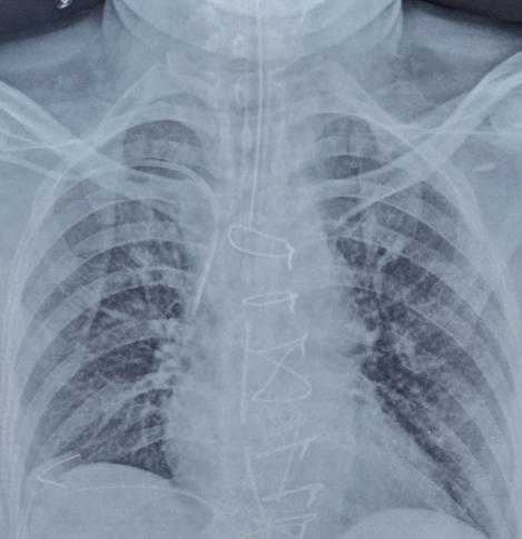 Figure 1: Immediate post op period.