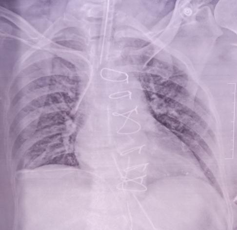 Figure 2: Post op day 1.