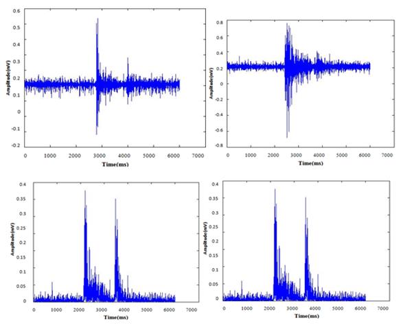 Figure 5: EMG signal analysis of lifting using trolley of 85cm height of an employee.