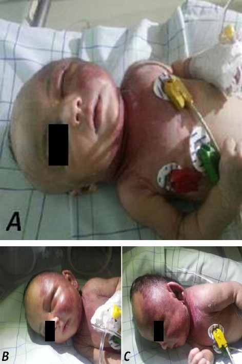 Figure 1: Clinical case of kaposiform hemangioendothelioma with kasabach-Merritt phenomenon diagnosed in a 3-days-old patient. Photos taken at the department level. Extension of cutaneous lesion: A violet-red lesion in the left hemiface with irregular margins and edema of the left eyelid (A). Laboratory tests showed normocytic normochromic anemia: hemoglobin at 8.1 g / dl and deep thrombocytopenia: platelet at 6000 /mm3. The workup of jaundice revealed that the grouping of the baby and her mother was: O+. Total bilirubin was at 150.46 mg / l; direct bilirubin at 11.22 mg / l and indirect bilirubin at 139.2 mg / l. C reactive protein test was normal.