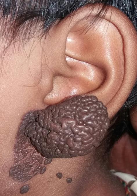 Figure 1: Melanoma of pinna.