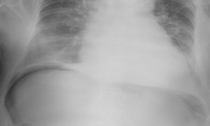 Figure 1: Abdominal and chest x-ray, showing free intraperitoneal air under the right diaphragm.
