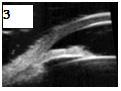 Figure 3: Mechanism of papillary pblock glaucoma with angle closure and anterior bowing of iris. Figure 4: Plateau iris with anterior insertion of iris into ciliary body and prominent ciliary process (white arrow). Phacomorphic glaucoma anterior subluxation of the lens may lead to angle-closure glaucoma. Because of the lens pushing the iris and ciliary body toward the trabecular meshwork (Figure 5a). Malignant Glaucoma: UBM clearly shows that iris lens diaphragm is displaced anteriorly with or without fluid in the supraciliary space (Figure 5b). In a recent study by Wang _et al.,_ the ciliary bodies were found to be thinner