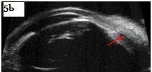 Figure 6: Shows a case with patent and functioning bleb, note clear subconjunctival fluid and peripheral iridectomy.
