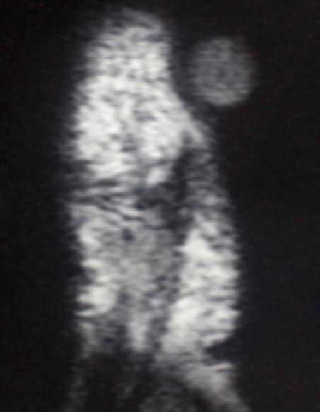 Figure 3: The surgical approaches ( transungual ) for excision of glomus tumor. An algorithmic approach to GT: