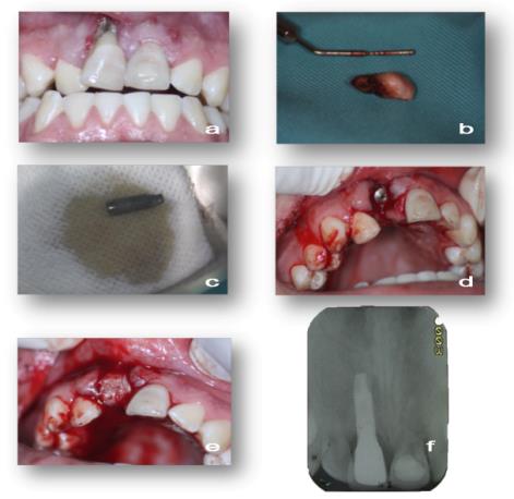 Figure 3: a) Central incisor lesion with apical decay and receding gum. b) Surgical access to proceed the central incisor extraction. c) PRF procedure where performed and dental implant was treated with PRF supernatant. d) Bone drilling was performing and was placed the treated dental implant. e) PRF autologous barrier was done and was placed into the alveolar socket protecting the dental implant. f) Sixty-days after surgery was performed the rehabilitation with ceramic crown and periapical radiography was taken suggesting the osseointegration.