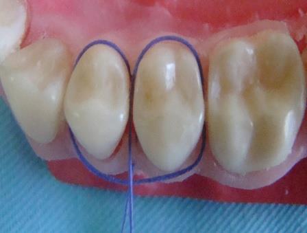 Figure 5: Oclusal view of the suture.