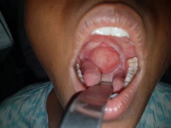 Figure 1: Globular mass in the oropharynx arising from the posterior pillar of left tonsil.