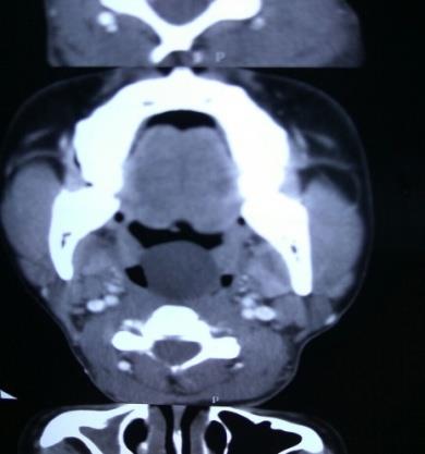 Figure 2: Non- enhancement of lesion on Contrast enhanced computed tomography (CECT).