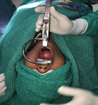 Figure 3: Patient placed in Rose position prior to excision of lesion.