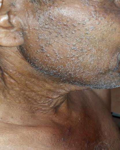 Figure 1: Multiple open comedones over the face.