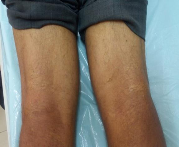 Figure 5: Yellowish papules over the right popliteal fossa.