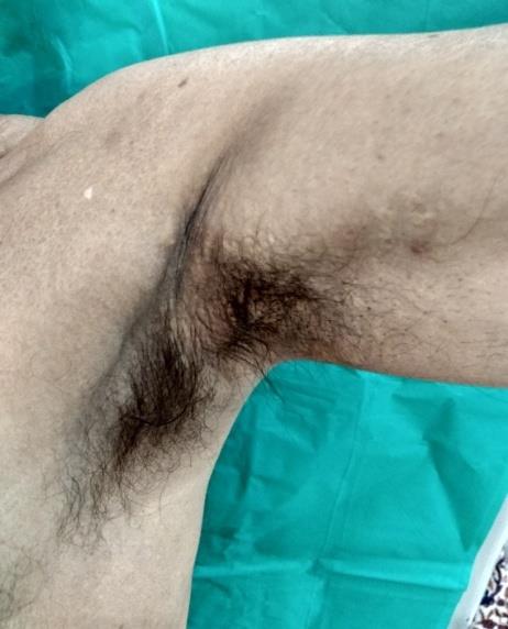 Figure 6: Yellowish papules and plaques over the bilateral axilla.