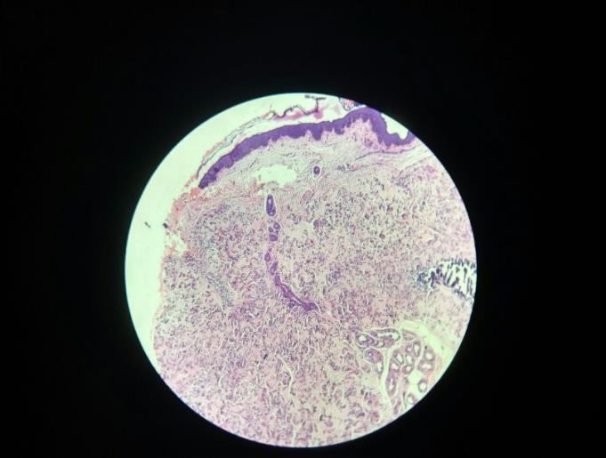 Figure 8: Irregularly clumped faintly basophilic elastic fibres admixed with mucoid material in the mid and lower dermis.