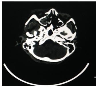 Figure 1: 3D Image of skull CT visualized the Fracture.