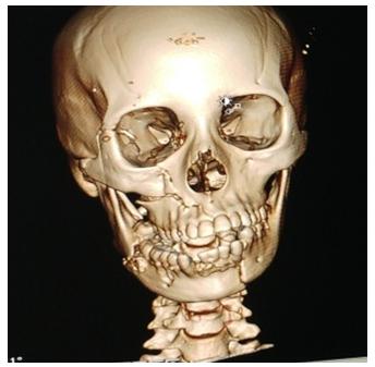 Figure 2: MPR Image of coronal CT skull that visualized the fracture.