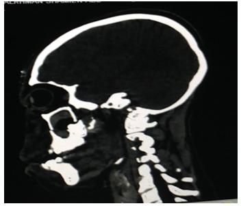 Figure 4: MPR image of sagittal CT skull that visualized the fracture.