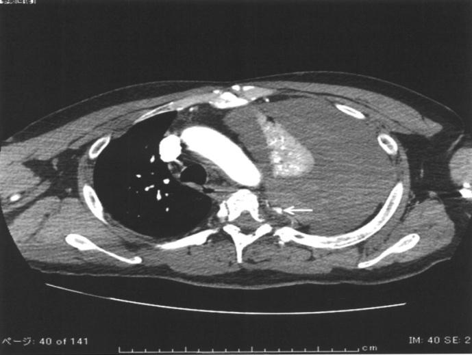 Figure 1: Contrast-enhanced computed tomography (CECT) at the presentation of sudden dyspnea and chest pain, which reveals massive pleural effusion, mediastinal right shift, left passive pulmonary atelectasis, and left fifth intercostal artery aneurysm. White arrow indicates the left fifth intercostal artery aneurysm.