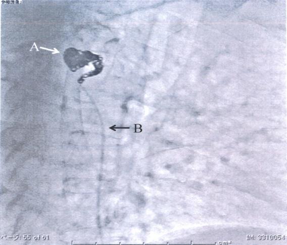 Figure 3: Selective arteriography to the left fifth intercostal artery after embolization. The intra-aneurysmal cavity and the proximal portion of the aneurysm are filled with coils. White arrow A indicates the fifth intercostal artery aneurysm. Black arrow B indicates the catheter for arteriography.