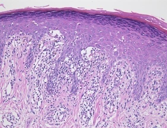 Figure 1: Oral Lichen Planus with saw-toothed rete ridges and band like inflammation in the upper dermis [9].