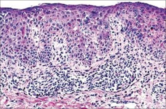 Figure 2: Prominent plasma cell infiltrate in Oral Lichen Planus [10].