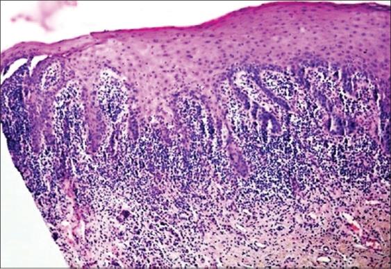 Figure 3: Mild epithelial dysplasia -Oral Lichen Planus [11].