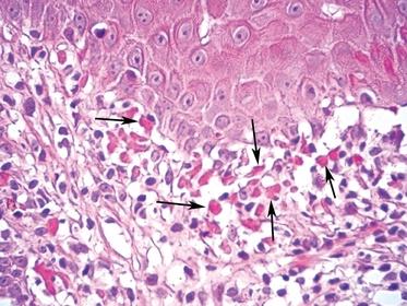 Figure 6: Lichenoid drug reaction with Civatte Bodies [13]. Lichenoid dysplasia generally delineates a lichen planus like histopathology arising in a dysplastic epithelium. In contrast, the inscription invalidates the occurrence of dysplastic alterations in an epithelium affected by LP. The descriptive concept confounds both the pathologists and the clinicians alike.