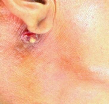 Figure 3: Clinical photograph showing post aural basal cell carcinoma.