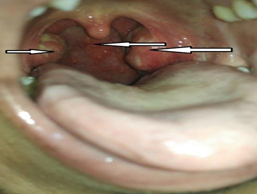 Figure 1: Bilaterally enlarged and inflamed tonsils, with congested posterior pharyngeal wall.