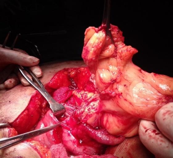 Figure 3: Operative photograph of Gastric lipoma. Post-operatively, the patient was kept on nasogastric aspiration, IV fluids, analgesics -Inj. Tramadol 50 mg IV 12 hourly, Inj. Ceftriaxone- 1 Gm IV 12 hourly and Inj. Pantoprazole 40 mg IV 12 hourly. She was allowed fluids on the 5th post-operative day and soft diet on the 7th post operative day. She recovered well and was discharged on the 9th day. The histopathology was diagnosed as “Lipoma” (Figure 4).