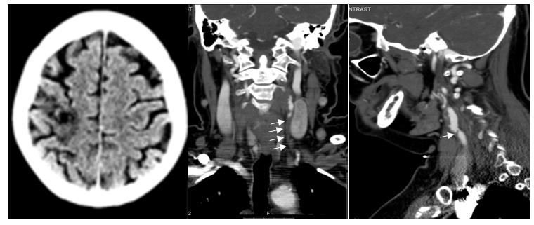 Figure 1: Left image: Cranial CT on admission showing the non-recent ischemia in cortico-subcortical right fronto- parietalregion. Angio CT on admission demonstrating occlusion of the left common carotid artery (middle image) and right internal carotid artery stenosis >80% (right image).